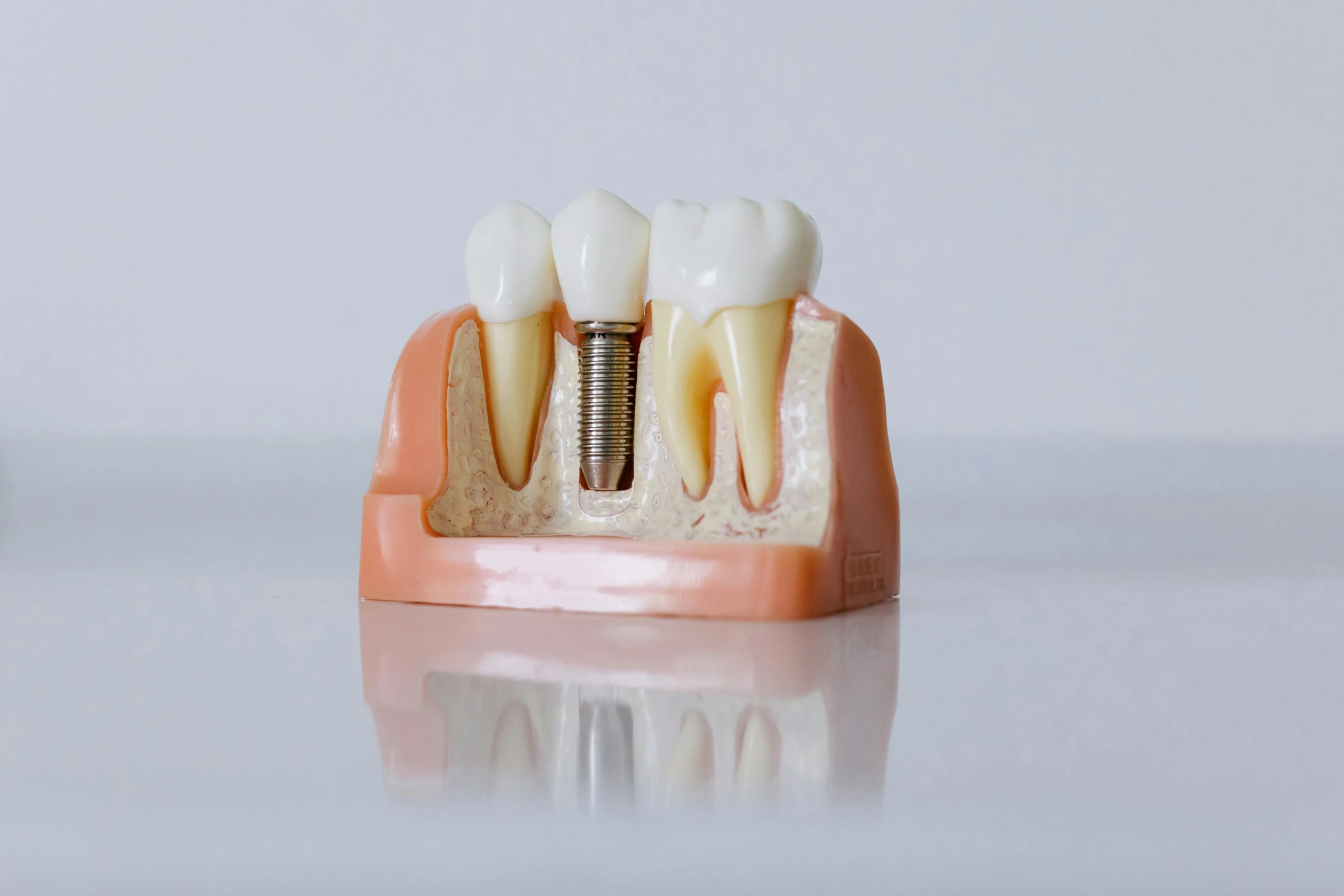 Implantes dentales en El Vendrell